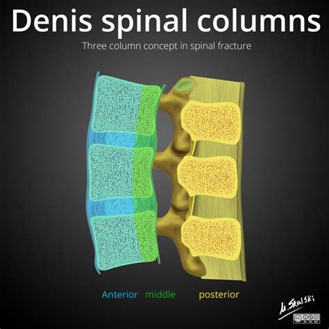 Three Column Concept Of Spinal Fractures Radiology Reference Article