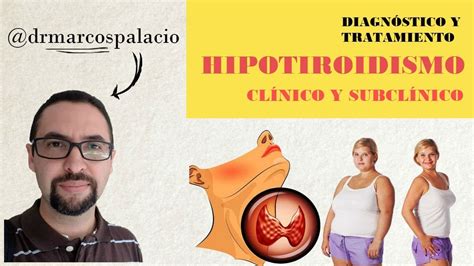 ¿cómo Diagnosticar Y Tratar El Hipotiroidismo Clínico Y Subclinico