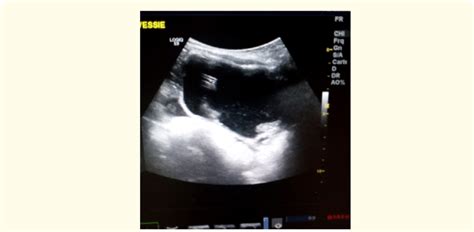 Abdominal Ultrasound Was Performed Showing An Intravesical Dialysis Download Scientific Diagram