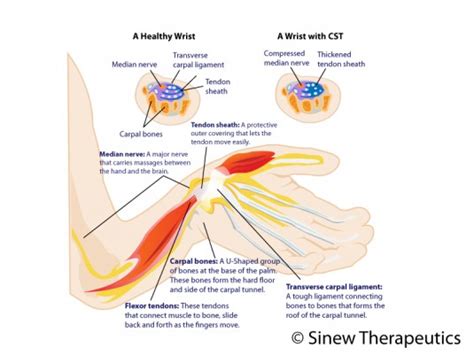 If so watch this video as dr. Tendinitis of the Wrist Information - Sinew Therapeutics