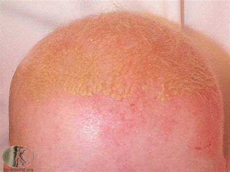 seborrheic dermatitis pictures scalp and face treatment evidence ehealthstar