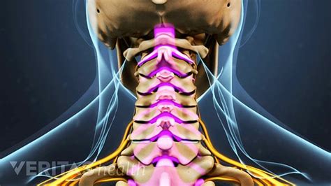 Cervical Stenosis With Myelopathy Symptoms Treatments Surgery