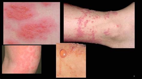Contact Dermatitis In Hattiesburg And Laurel Ms