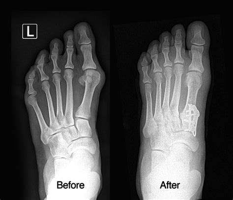 Before And After X Ray Photos For Bunion Surgery Yelp