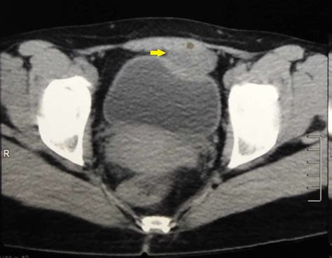 Cureus A Rare Case Of Urachal Cyst In A Patient With Uterine Fibroids Hot Sex Picture