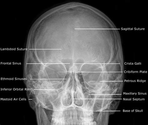 Rxdentistry Radiographic Anatomy Of Facial Bones