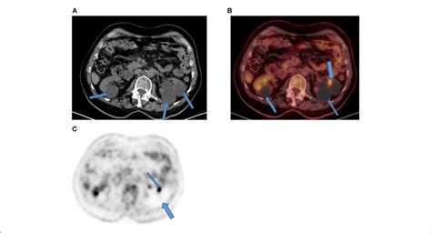 Focal Kidney Uptake Axial Ct A Component Of The Petct Showed