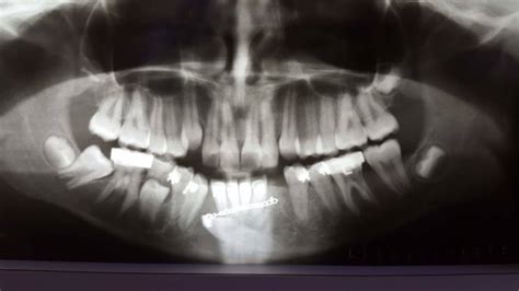 For 2 weeks (8 weeks if you had lower wisdom teeth extracted), do not eat hard, crunchy, or very chewy. Gum Flap Hanging From Back of Wisdom Tooth