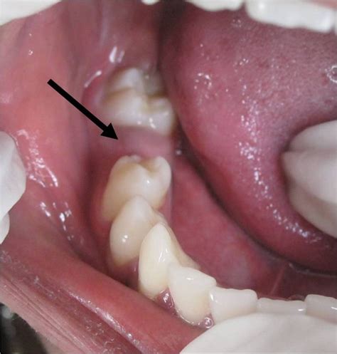 Dentigerous Cyst A Common Lesion In An Uncommon Site Bmj Case Reports