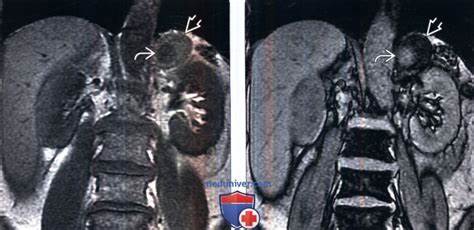 Лучевая диагностика смешанной опухоли надпочечника Картинка - Лучевая диагностика смешанной опухоли надпочечника