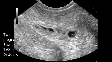 Early 1st Trimester Twin Pregnancy At 5 Weeks Transvaginal Ultrasound