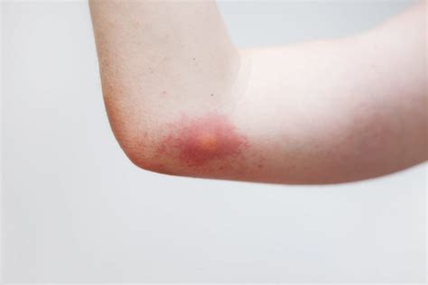 What Are The Symptoms And Treatments Of Wasp Stings Facty Health