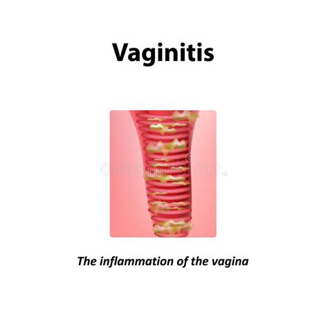 Infiammazione Della Vagina Vaginite Infographics Illustrazione Di