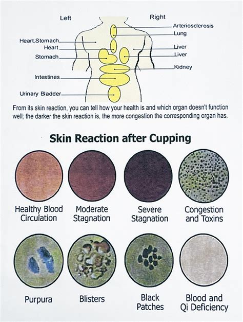 Cupping Therapy Toronto Reflexology