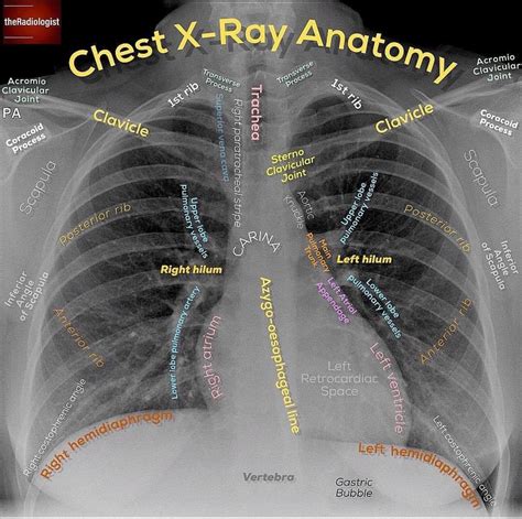 Chest Xr Radiology Medical Anatomy Anatomy