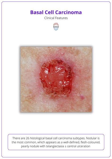 Basal Cell Carcinoma Bcc Aetiology Diagnose Treat Follow Up