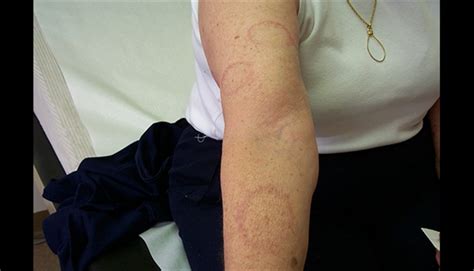 Clinical Challenge Annular Erythematous Patches Mpr