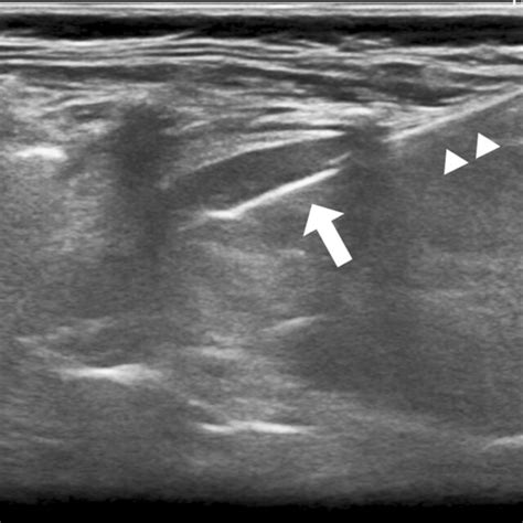 Longitudinal Ultrasound Of The Left Kidney In A Year Old Girl With Download Scientific