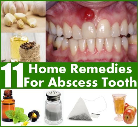 11 Home Remedies For Abscess Tooth Diy Home Things