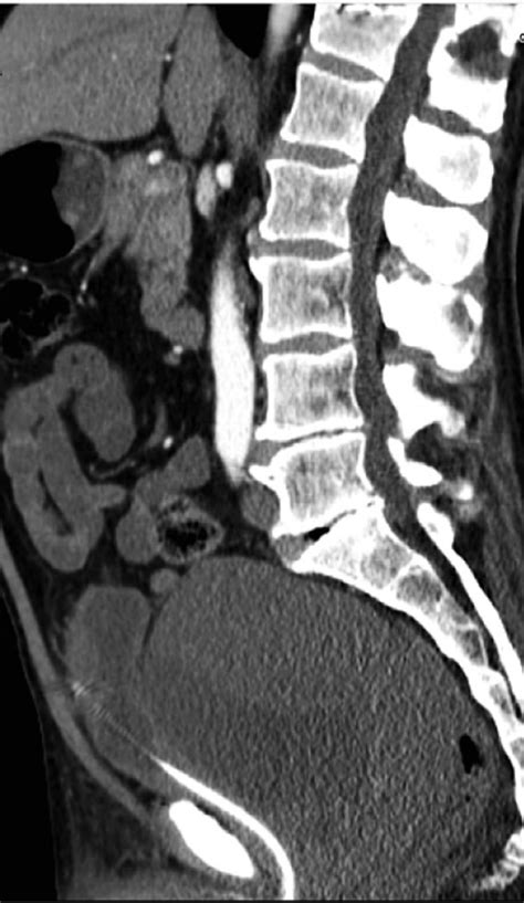 Sagittal Reconstruction Ct Scan After Contrast Administration The