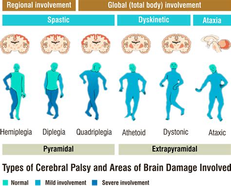 Types Of Cerebral Palsy Brain