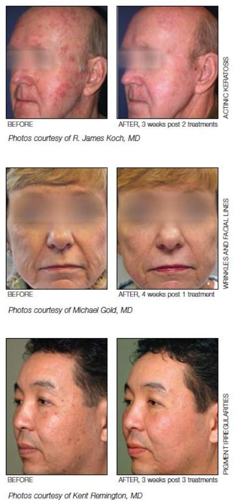 Fractional Laser Treatment Scottsdale Skin And Holistic Health