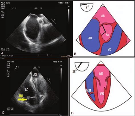Transesophageal Echography Using A Multiplanar Probe A Midesophageal