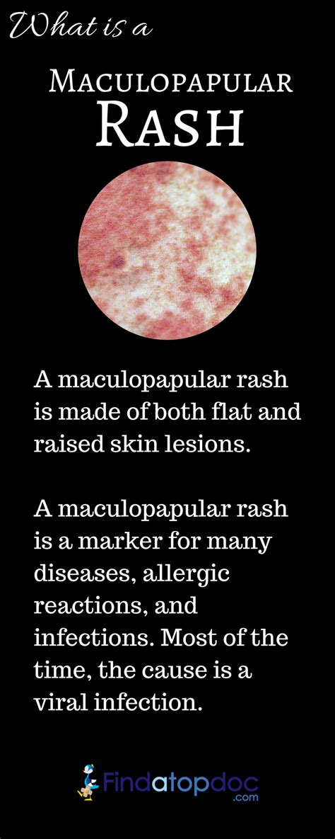 What Is A Maculopapular Rash Infographic