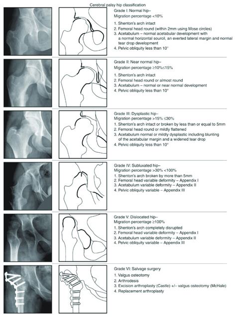Radiographs And Diagrams Showing The Melbourne Cerebral Palsy Hip