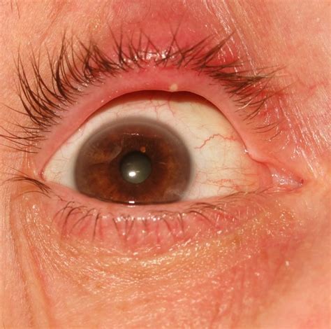 Stye Pictures Contagious Symptoms Causes Treatment 2018 Updated