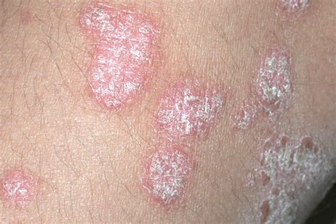 Stress As An Influencing Factor In Psoriasis