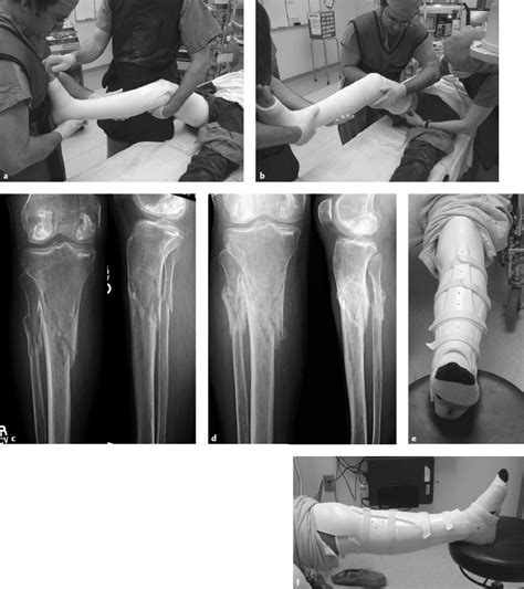 Tibial Shaft Fractures Musculoskeletal Key