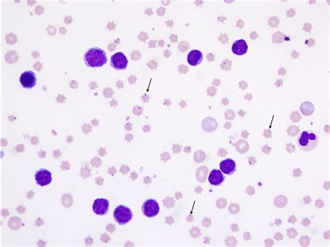 Blood Smear Depicting Concurrent Presence Of Bovine Leukemia Virus Blv