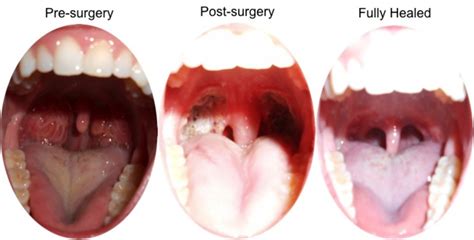 Adenoidectomy And Tonsillectomy Surgery Trialexhibits