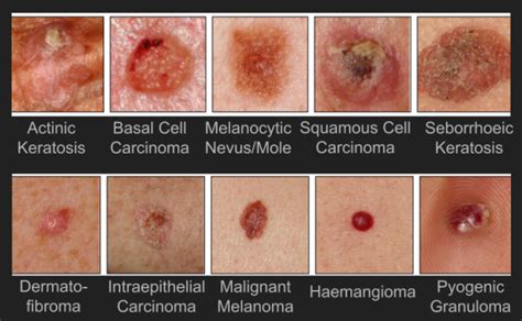 Deep Features To Classify Skin Lesions Summary And Slides Kawaharaca