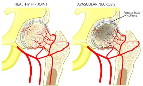 Understanding Avascular Necrosis Surgery Avn Surgery Dr