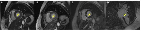 Painless Thyroiditis And Myocarditis Medizzy