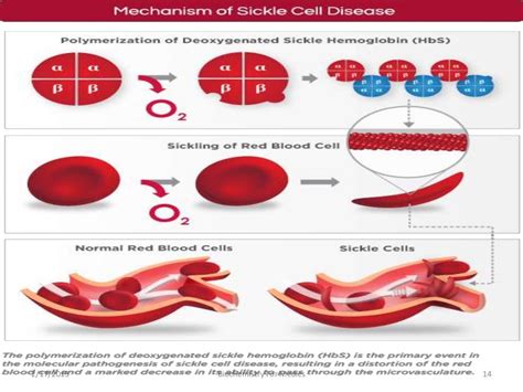 Sickle Cell Anemia An Overview