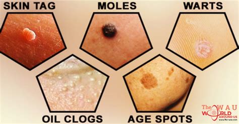 How To Easily Remove Skin Tags Moles Blackheads Spots And Warts By