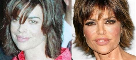 Lisa Rinna Lips Plastic Surgery Before And After Lisa Rinna Lip