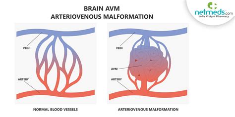 What Is Arteriovenous Malformation Types Symptoms Tre