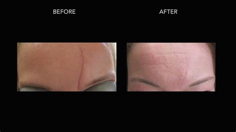 Scar Treatments Before And After Photos Dermmedica