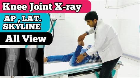Knee Joint Xray Position Ap Lat Skyline View Skyline View X Ray