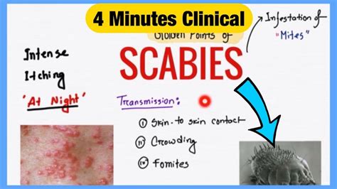 Scabies Spot Diagnosis And Prescription Symptoms Pathogenesis