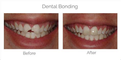 Cosmetic Dentistry Bonding Before And After Dental News Network
