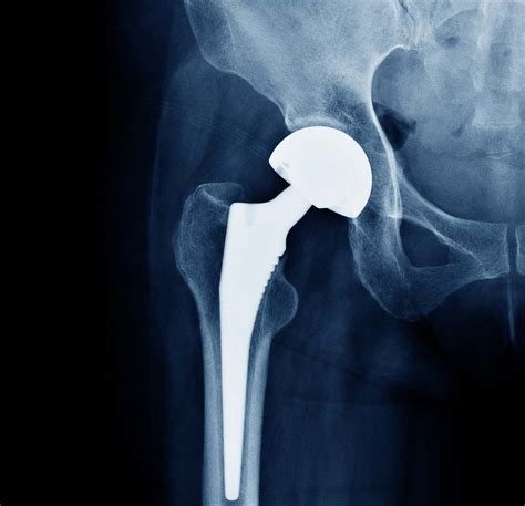 Total Hip Replacements Dr Andre Olivier Orthopaedic Surgeon