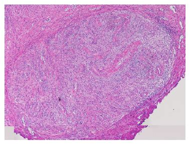 Aspectos histopatológicos iniciales de la hiperplasia benigna de próstata nódulos mixo
