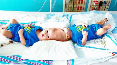 Rare Conjoined Twins To Be Separated Wkrc