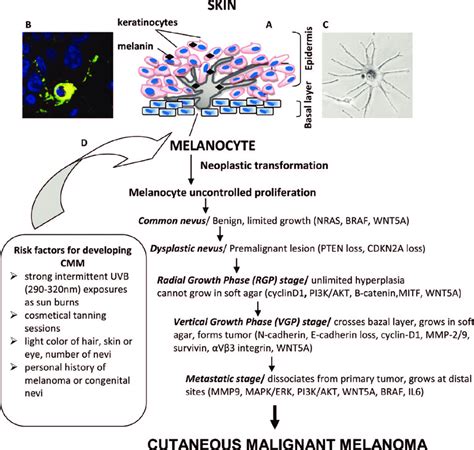 Cutaneous Malignant Melanoma A Schematic Representation Of Epidermal