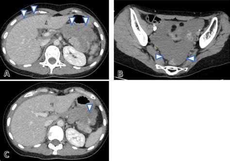 Contrast Enhanced Abdominal Computed Tomography Ct Conducted In The